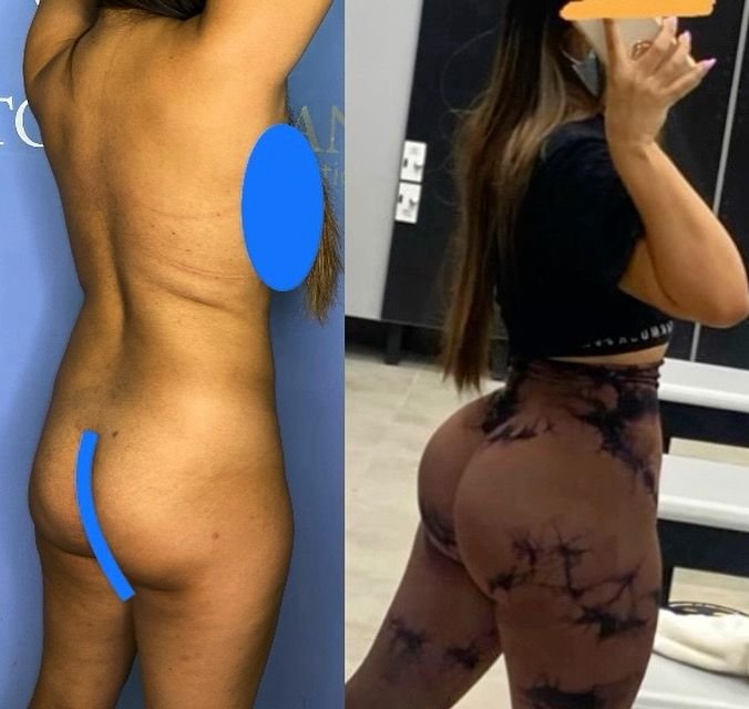 Before and after result 3