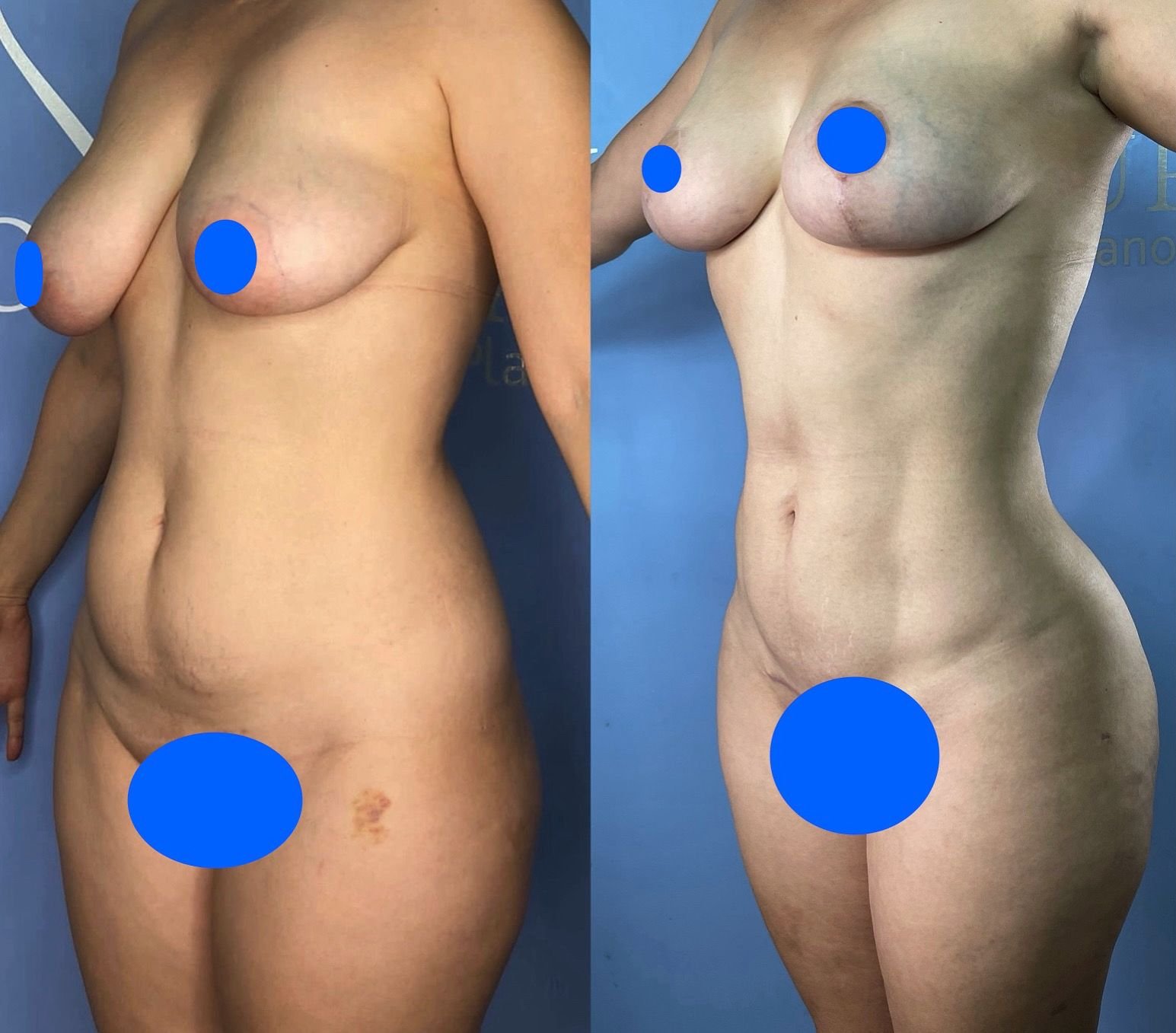 Before and after result 4