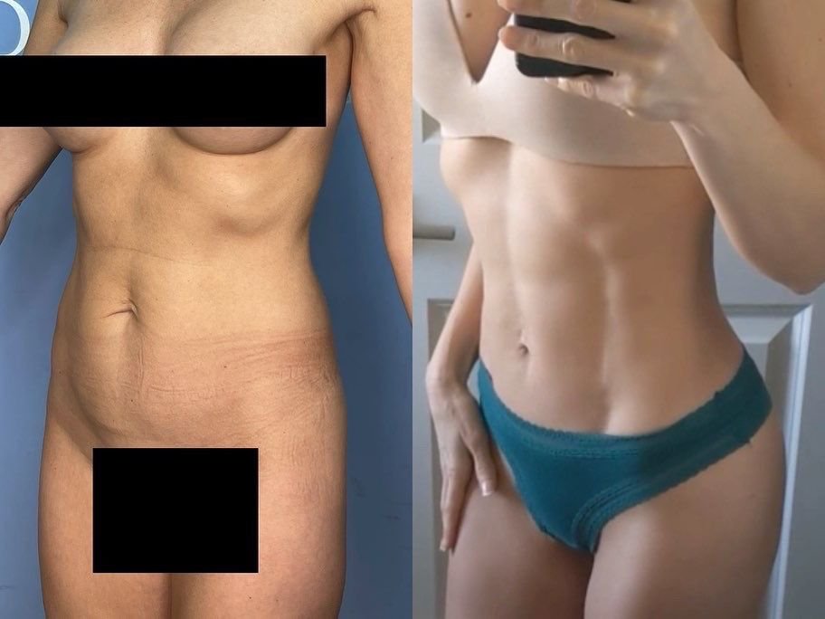 Before and after result 5